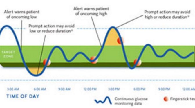 Continuous Glucose Monitor: Dexcom vs Medtronic